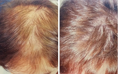 Before and after photo of female hair loss treatment