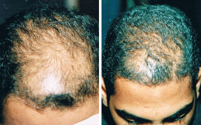Before and after photo of male hair loss treatment